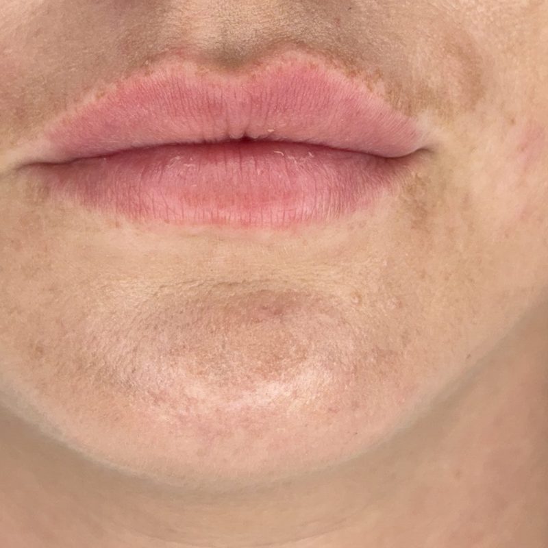 Læber før permanent makeup